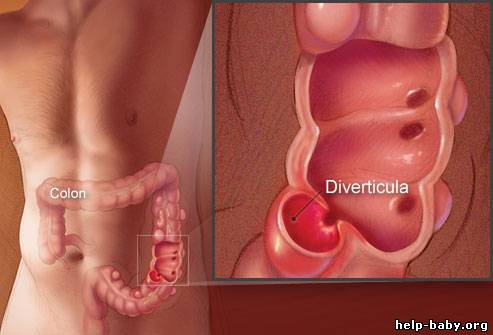 Diverticular Disease Diet Treatment